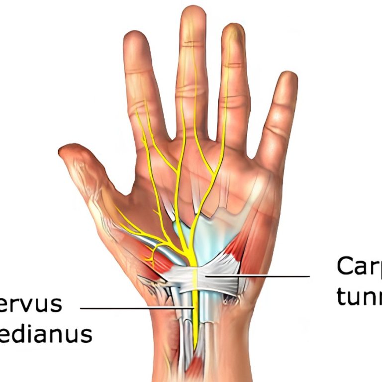 Carpal Tunnel Syndrome Treatment in Delhi: Causes, Symptoms & Best Solutions