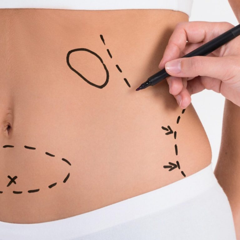 Liposuction Treatment in Delhi