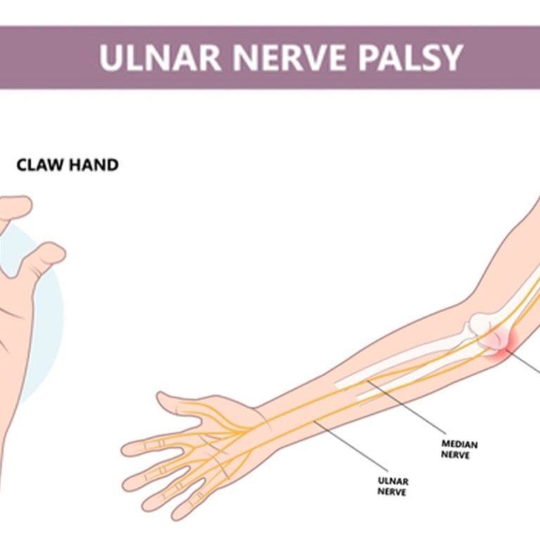 Ulnar Nerve Palsy Treatment in Delhi