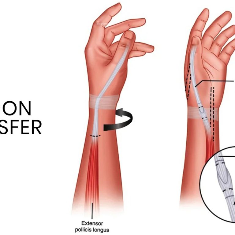 tendon transfer surgery