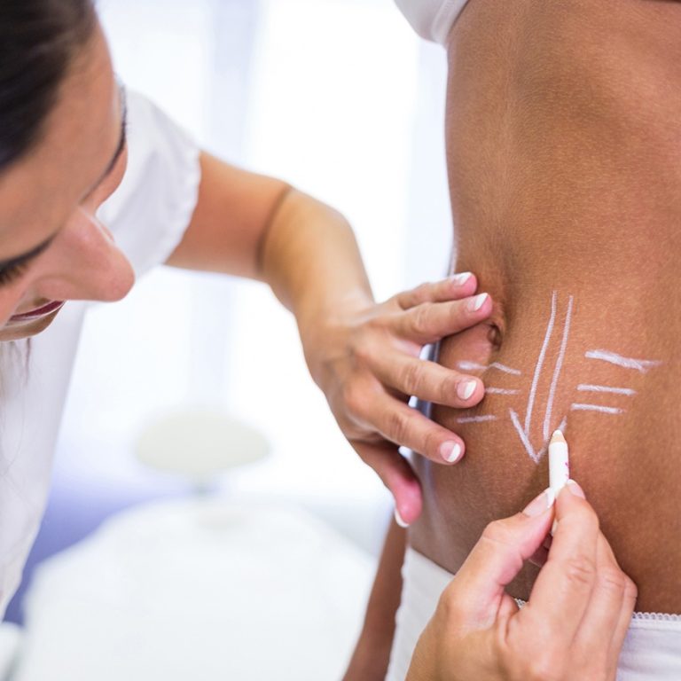 body countring surgery in delhi by Dr Anubhav Gupta