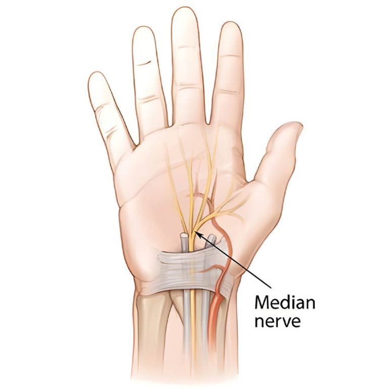 Median Nerve Palsy: Causes, Symptoms, Diagnosis by Dr Anubhav Gupta