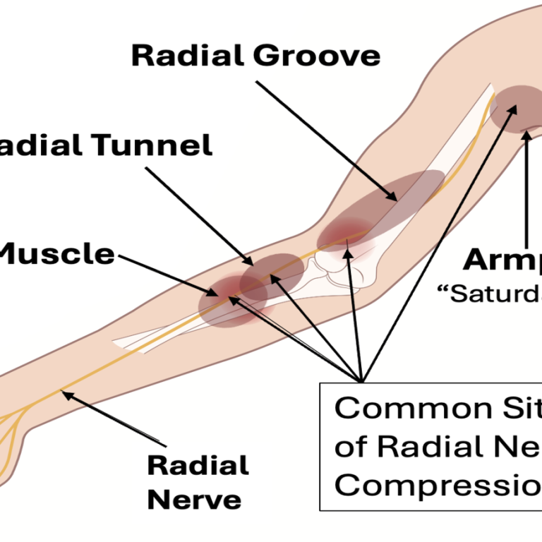 Radial Nerve Palsy Treatment: Causes, Symptoms, Recovery & Best Doctor