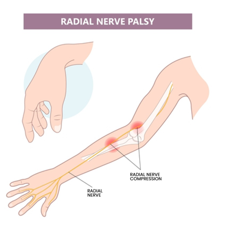 Radial Nerve Palsy Treatment | Dr. Anubhav Gupta